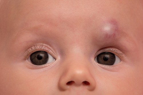 Hämangiombehandlung Kind mit großem Hämangiom über dem Auge