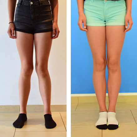 Kind mit X-Beinen vor und nach der Behandlung